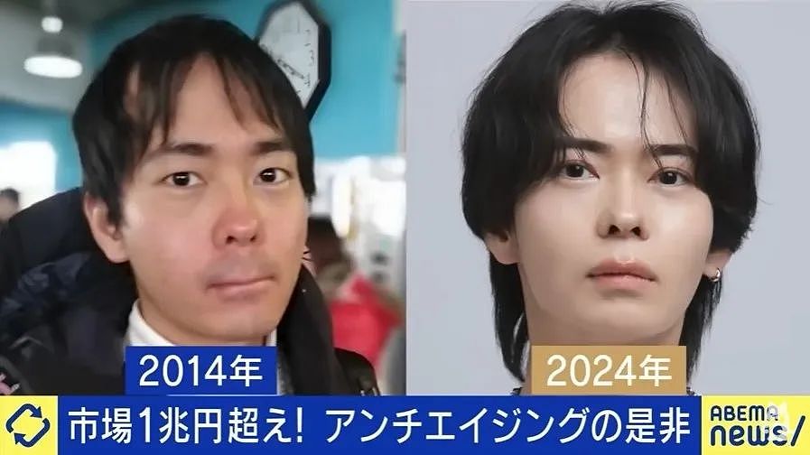 小哥长得太着急,23岁秃头还被甩!他努力抗老十年,现在...算逆生长吗?(组图) - 1