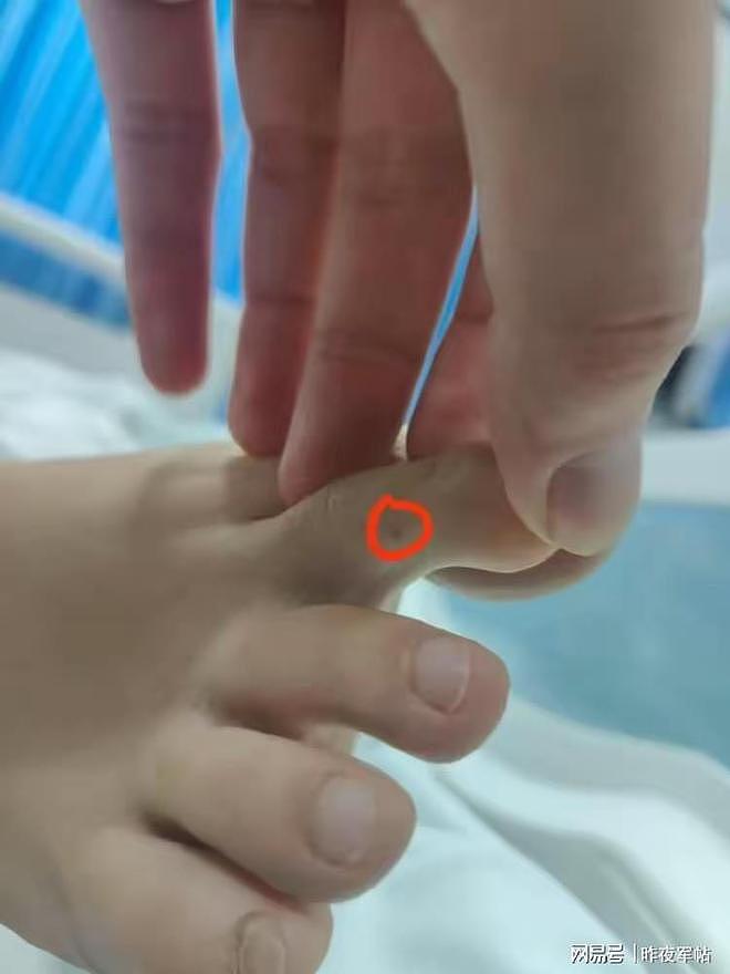三亚毒蛇咬死人，医生表现像小白！深圳蛇咬人抢救成功率有多高？（组图） - 2