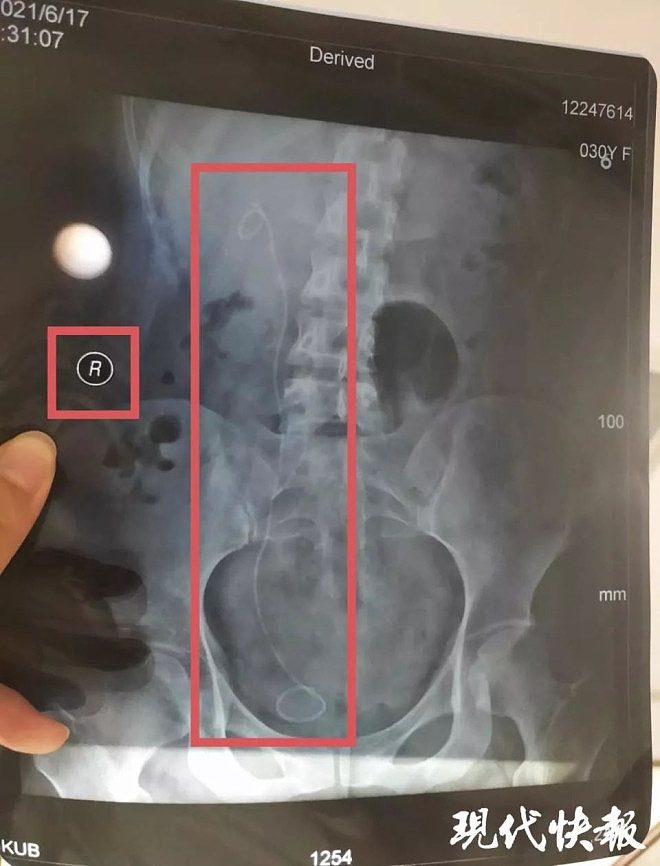 医生左右不分把支架装进正常输尿管,三名医生医疗事故仅处罚一助手(组图) - 2