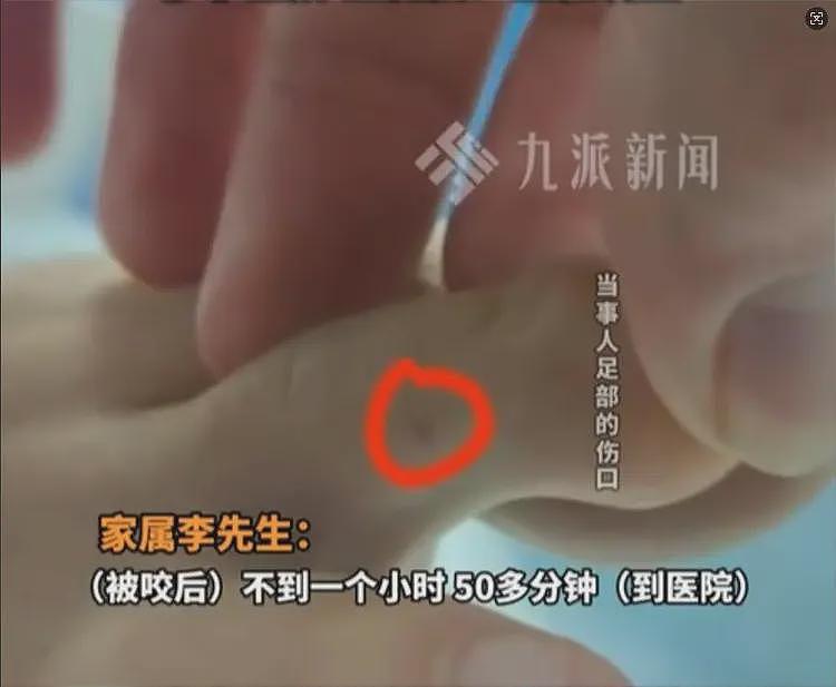 三亚女游客被中毒身亡后续！医学博主提出质疑，不是蛇咬而是毒虫（组图） - 15