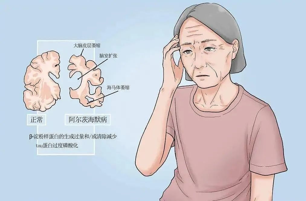 全球首创!澳洲开发老年痴呆“神药‘,真的有效!数百万老人有救了...(组图) - 8
