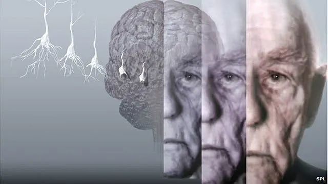 全球首创!澳洲开发老年痴呆“神药‘,真的有效!数百万老人有救了...(组图) - 10