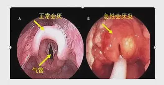 32岁男子“刀片嗓”硬扛一夜,医生:再晚半小时,人就没了!千万别以为是感冒(组图) - 2