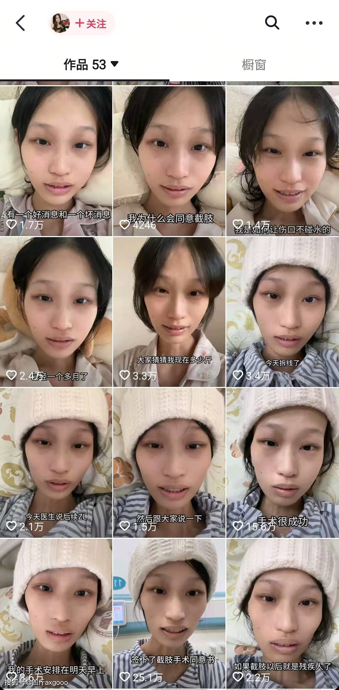 太揪心！21岁抗癌女孩饭饭病情再次恶化，截肢后癌细胞又肺转移（组图） - 2