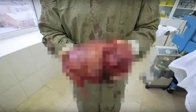 俄罗斯大力水手哥要废了… 给双臂打6升凡士林变大,现在只能切...(组图) - 13