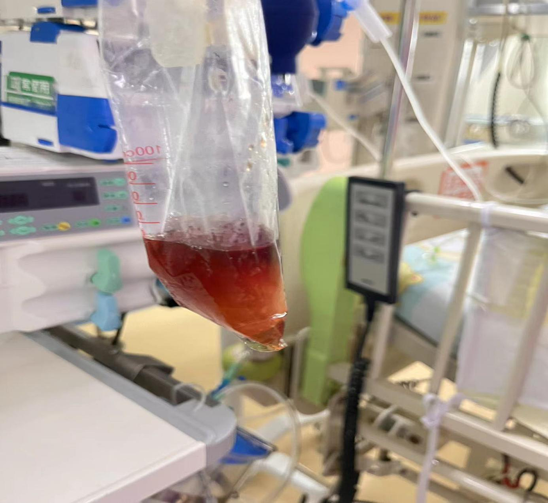 吃了一包零食，5岁娃进了ICU！这病南方高发，很多家长不知道（组图） - 1