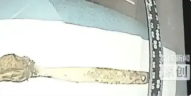 惊呆！男子泰国旅行离奇“失忆“，半年后肚子里竟发现15厘米的咖啡勺（组图） - 6
