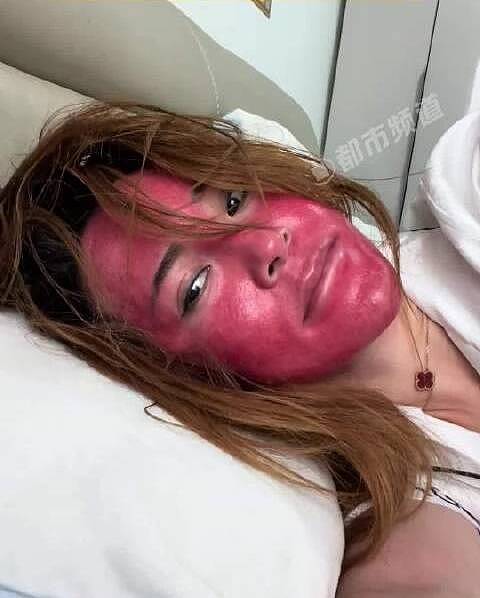 不卸妆22年？中国女变“关公”，脸部红肿硬如壳（组图） - 1