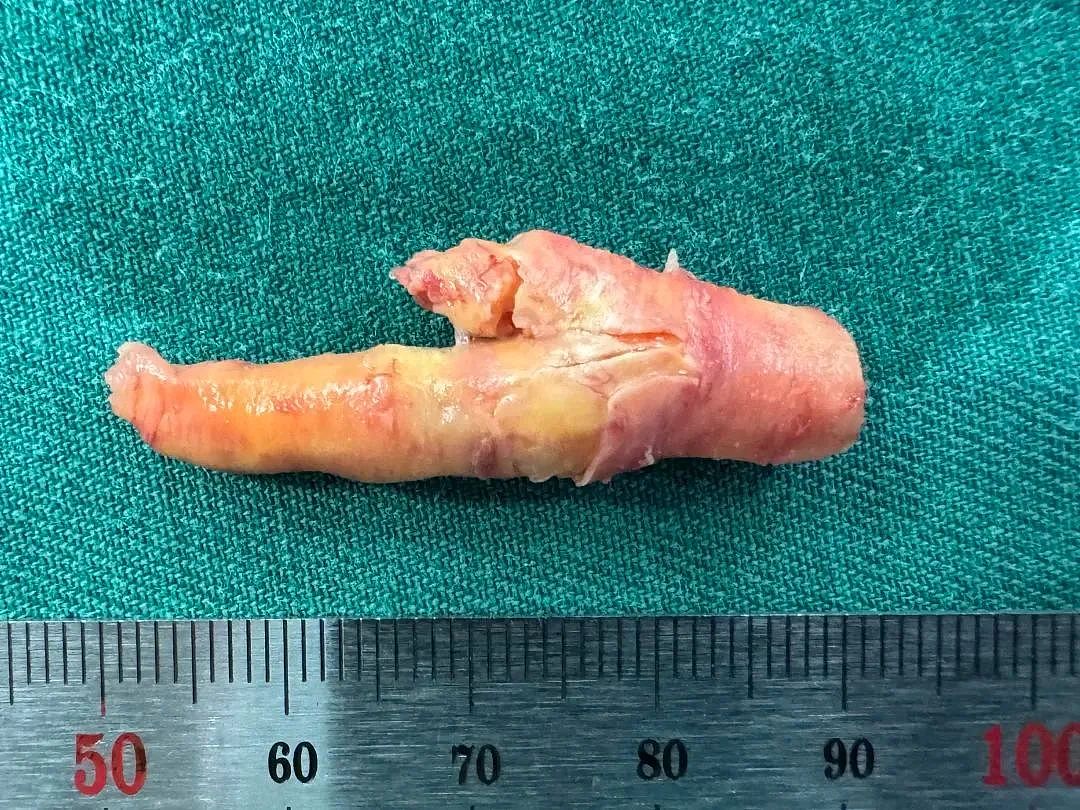 惊呆！男子血管里掏出一只“鸡爪”，这个习惯很多人都有，年龄到了请务必重视（组图） - 1