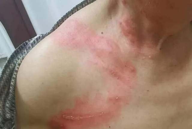毒液堪比硫酸!女子摸了下脖子就“中招”!千万别碰,有人差点毁容(组图) - 4