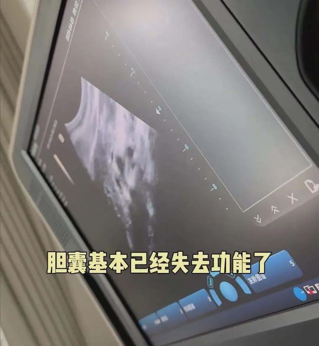 36岁知名女演员确诊，“已基本失去功能”！多位明星已“切除”，这种病与饮食、生活习惯有关（组图） - 2