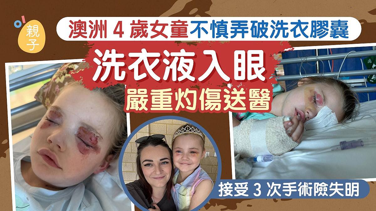 澳洲4岁女童不慎弄破洗衣胶囊，眼睛严重灼伤接受3次手术险失明（组图） - 1