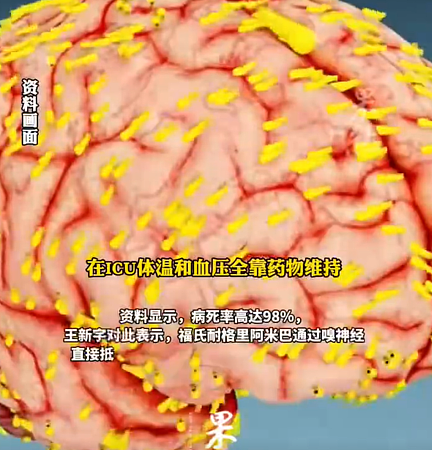 从鼻孔入侵!5岁女泡温泉感染“食脑虫”,医生:致死率超97%(组图) - 6