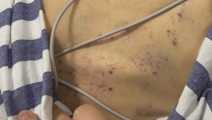 云南女子凌晨上厕所被毒蛇咬伤,口吐鲜血命悬一线(图) - 1