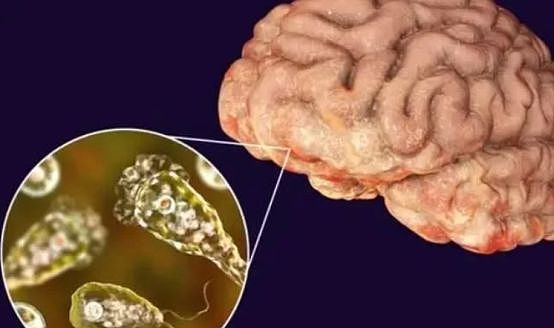 致死率97%！5岁女童感染“食脑虫”昏迷不醒，和玩水有关？（组图） - 3