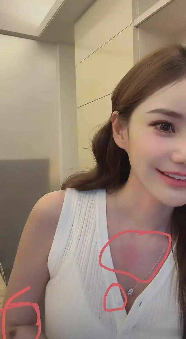 马筱梅深夜直播不挂链接，手臂淤青、胸口红肿，汪小菲被质疑家暴（组图） - 2