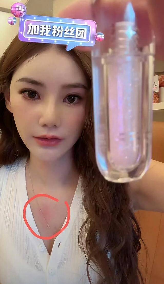 马筱梅深夜直播不挂链接，手臂淤青、胸口红肿，汪小菲被质疑家暴（组图） - 1