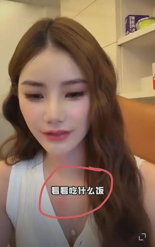 马筱梅深夜直播不挂链接，手臂淤青、胸口红肿，汪小菲被质疑家暴（组图） - 3