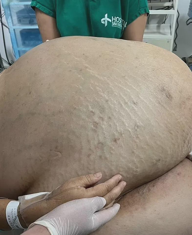 这玩意居然是个瘤？小哥肿瘤半年长到70斤，比两腿都粗！拖5年终于切了...（组图） - 8