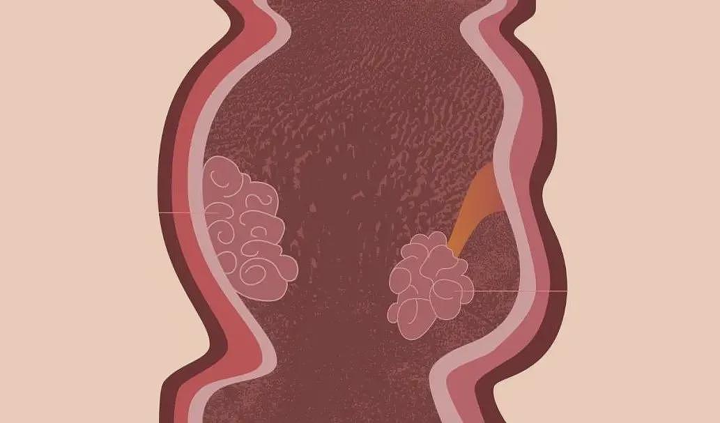 【健康】排便出现4种异常,可能是肠道长了息肉(组图) - 3