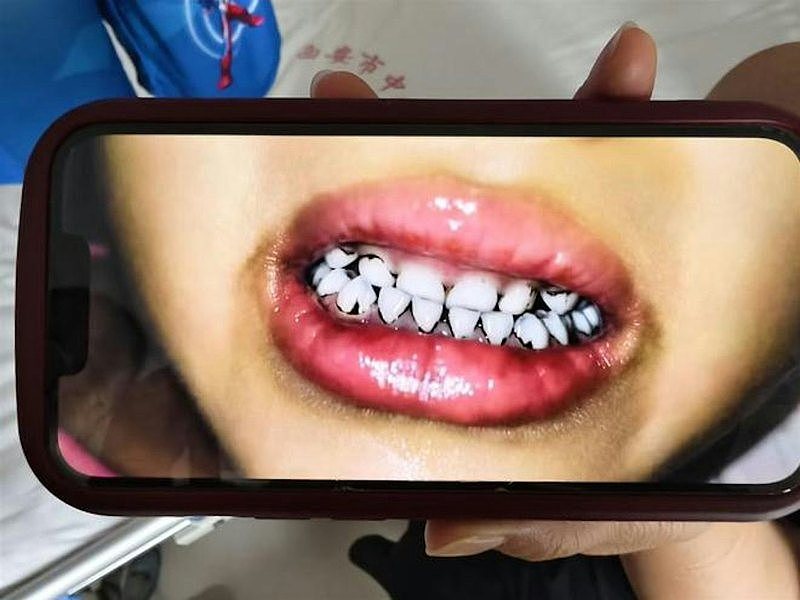 中国甘肃幼儿园疑食物违规用添加剂，多名幼儿血铅狂超标有人牙齿发黑（视频/组图） - 1