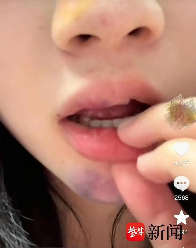 女孩景区蹦极撞成脑震荡:以为脸上是眼泪,一摸是血(组图) - 3