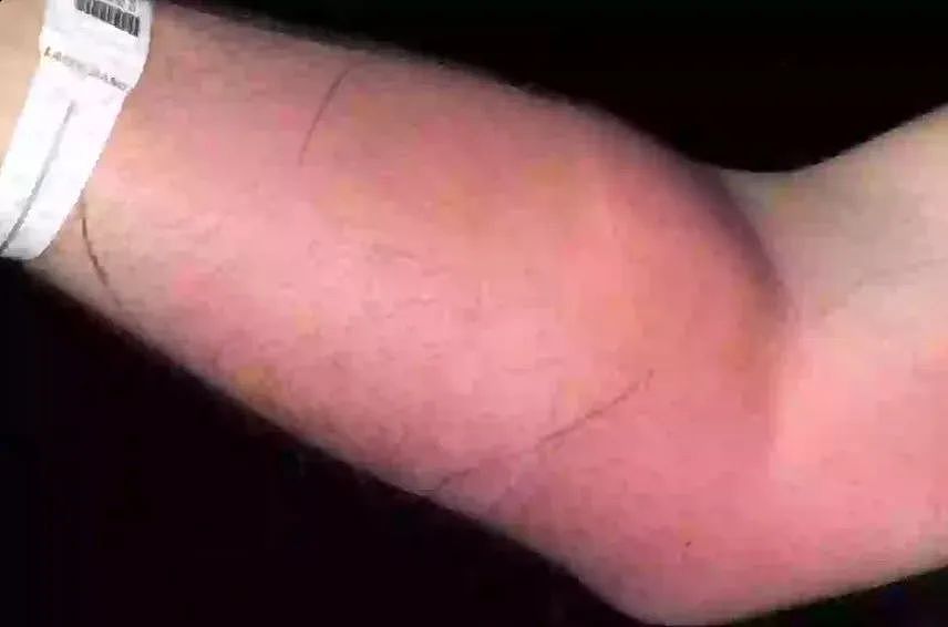 男子腰痛不止，往胳膊上注射自己精液，每天3管，什么脑回路？（组图） - 2