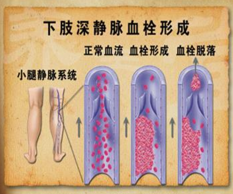 从新西兰飞广州,30岁华人女子落地后晕倒猝死!“经济舱综合症”引发警惕!(组图) - 5