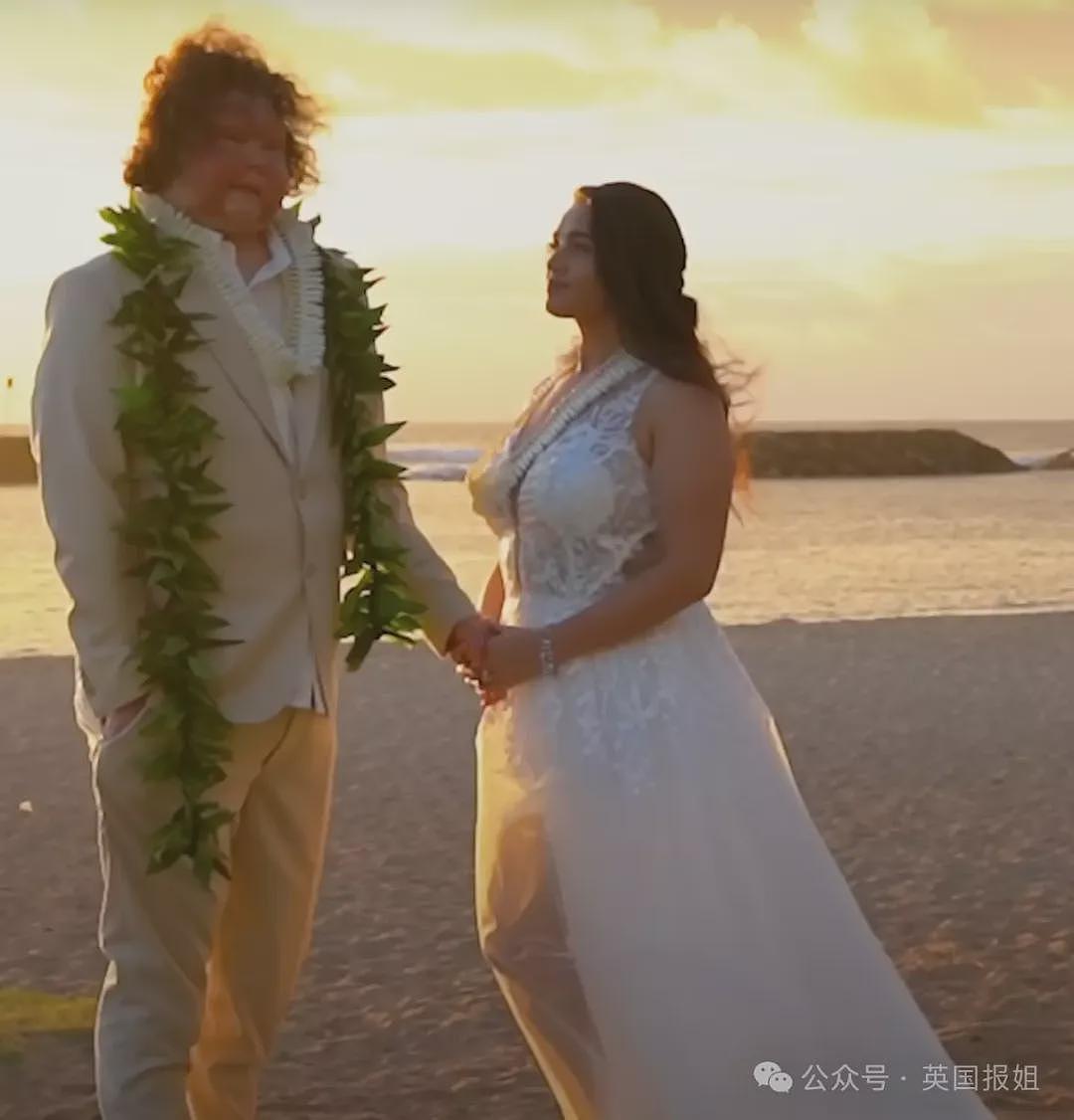 全球首例移植全脸手术男子结婚！车祸毁容换脸后拍视频爆红，网恋美女护士成功（组图） - 18