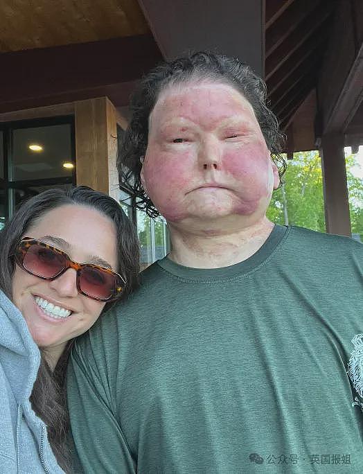 全球首例移植全脸手术男子结婚！车祸毁容换脸后拍视频爆红，网恋美女护士成功（组图） - 14