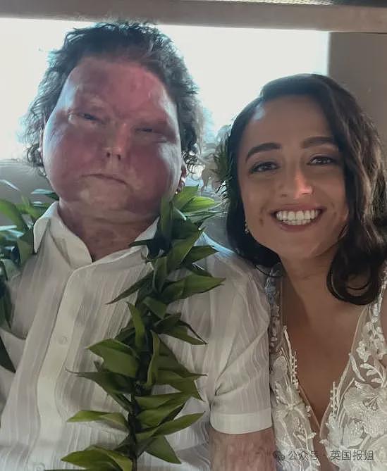全球首例移植全脸手术男子结婚！车祸毁容换脸后拍视频爆红，网恋美女护士成功（组图） - 17