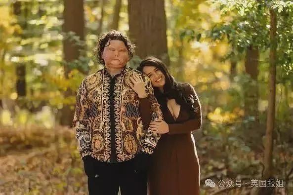 全球首例移植全脸手术男子结婚！车祸毁容换脸后拍视频爆红，网恋美女护士成功（组图） - 15