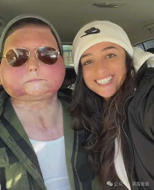 全球首例移植全脸手术男子结婚！车祸毁容换脸后拍视频爆红，网恋美女护士成功（组图） - 16