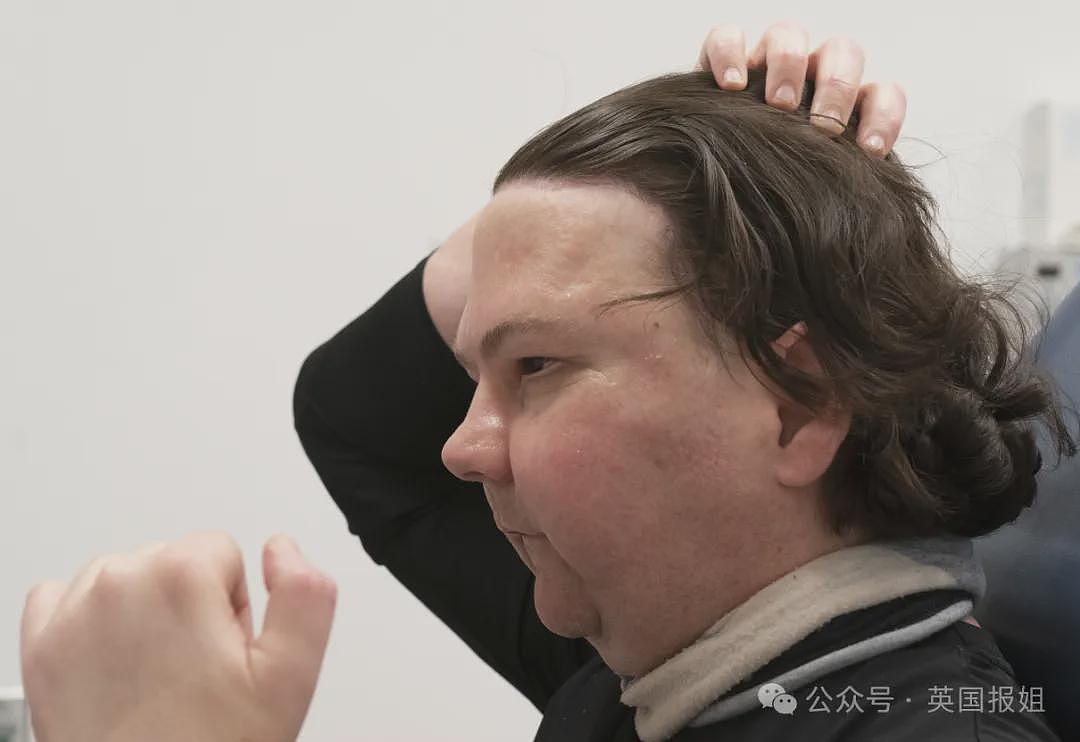 全球首例移植全脸手术男子结婚！车祸毁容换脸后拍视频爆红，网恋美女护士成功（组图） - 10