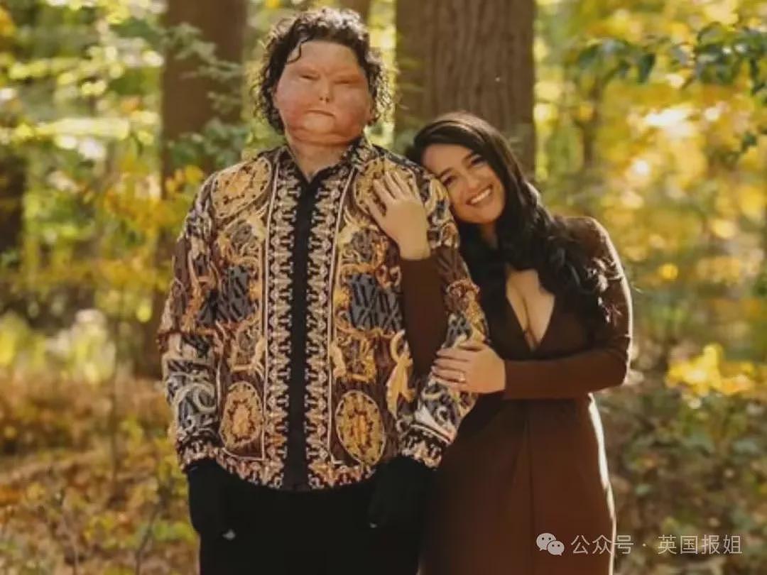 全球首例移植全脸手术男子结婚！车祸毁容换脸后拍视频爆红，网恋美女护士成功（组图） - 19
