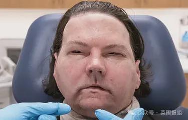 全球首例移植全脸手术男子结婚！车祸毁容换脸后拍视频爆红，网恋美女护士成功（组图） - 12