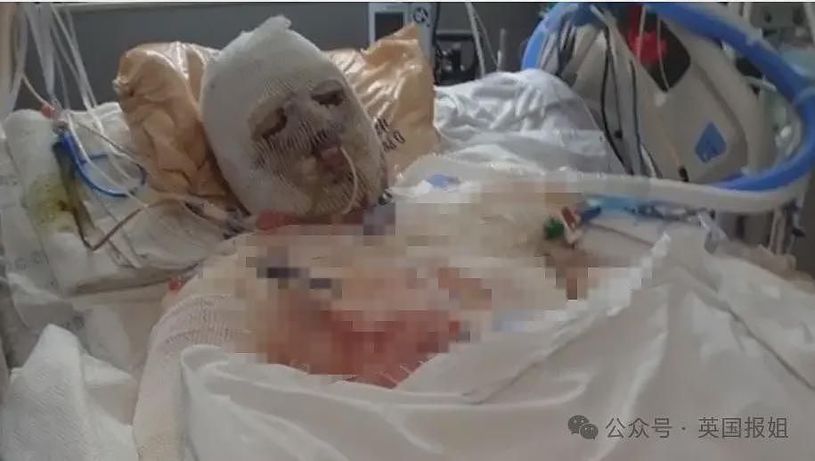 全球首例移植全脸手术男子结婚！车祸毁容换脸后拍视频爆红，网恋美女护士成功（组图） - 5