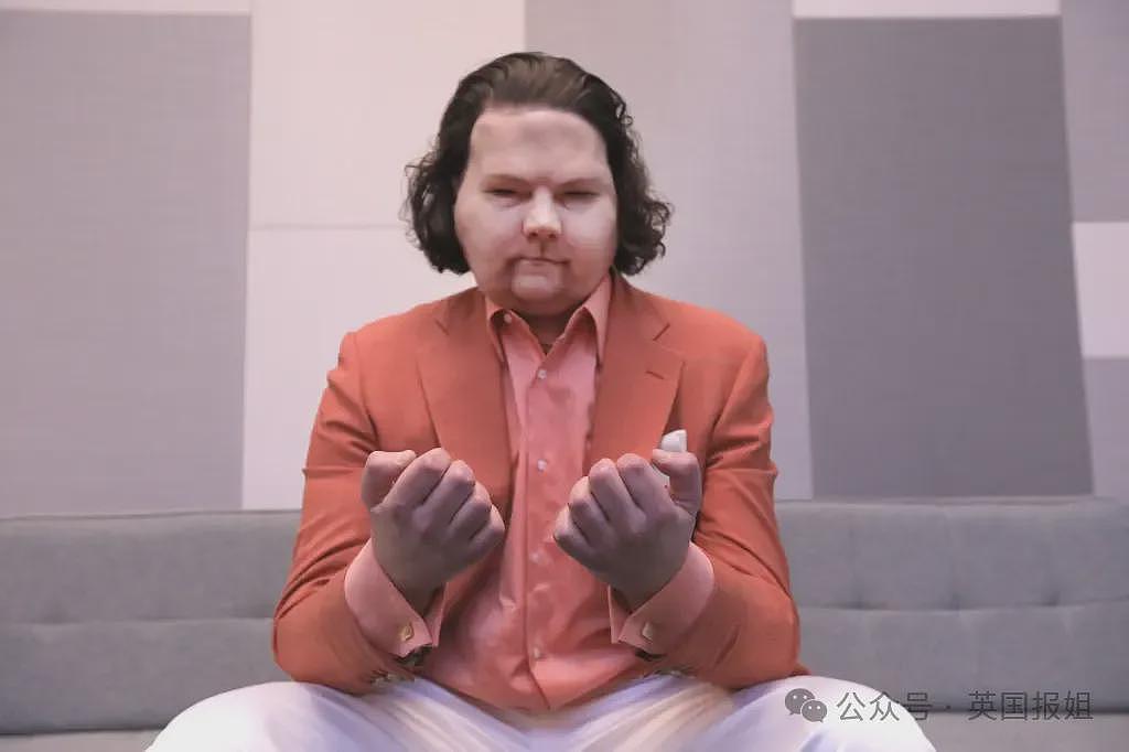 全球首例移植全脸手术男子结婚！车祸毁容换脸后拍视频爆红，网恋美女护士成功（组图） - 11