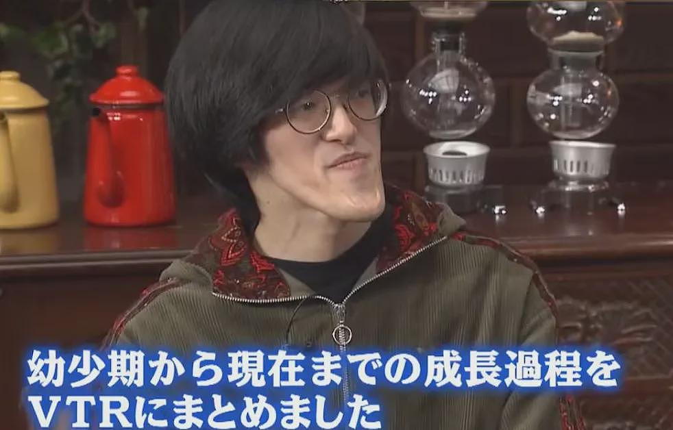 外国小哥超长鞋拔子下巴火了!一照X光吓坏医生:这还是人类吗(组图) - 7