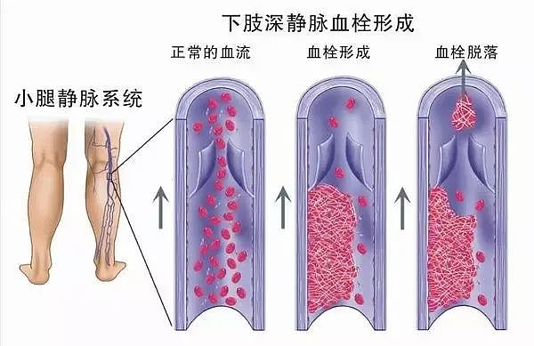 噩耗！30岁华女坐11小时飞机回国，下机10分钟猝死！“沉默杀手”专盯这几类人（组图） - 3
