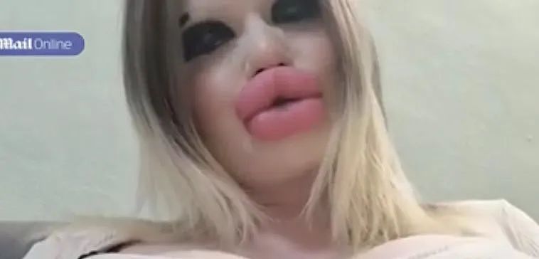 女子整容成超级巨唇，在看牙时遭医生拒诊！医生：你嘴唇太大，没办法啊...（组图） - 10