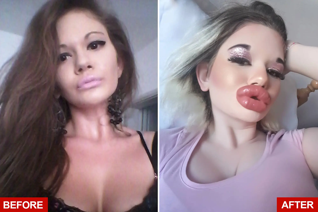 美女砸20万丰唇成“世界最大嘴唇”悲惨翻车！“牙疼得要死却没牙医敢掰开我的嘴…”（组图） - 3