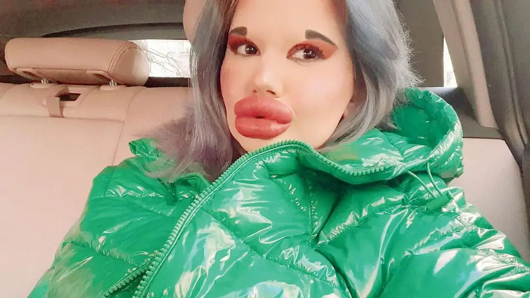 美女砸20万丰唇成“世界最大嘴唇”悲惨翻车！“牙疼得要死却没牙医敢掰开我的嘴…”（组图） - 15