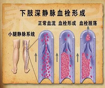 可怕!30岁华人坐11小时飞机回国,落地就猝死!这些人要警惕,别再拖延(组图) - 3