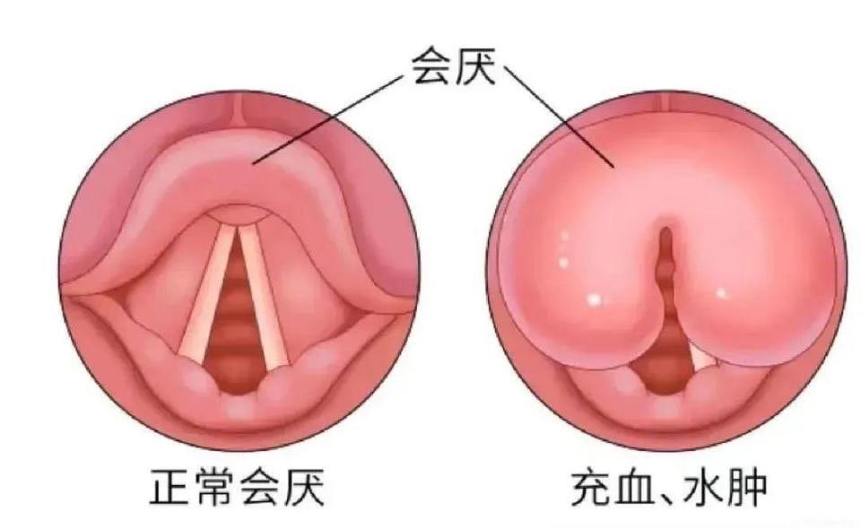不是感冒！男子“刀片嗓”硬扛一夜差点丧命，医生警告（组图） - 3