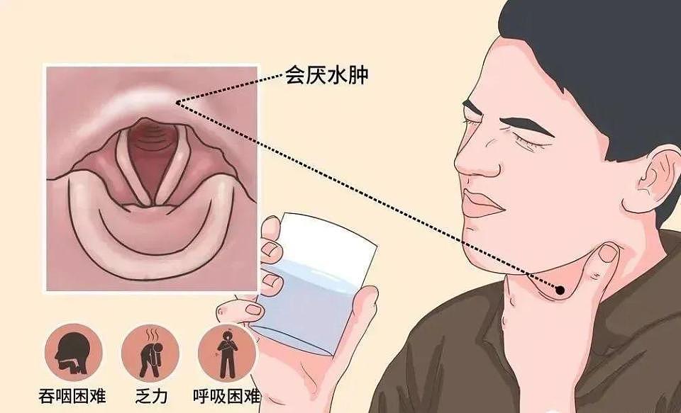 不是感冒！男子“刀片嗓”硬扛一夜差点丧命，医生警告（组图） - 4