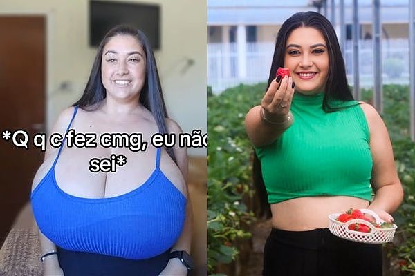 22岁女胸前顶12kg西瓜奶!患巨乳症超自卑,募资缩胸11kg(图) - 1