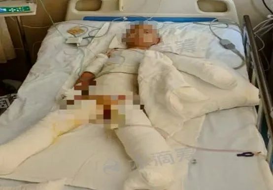 揪心！这场意外爆炸刷屏，女儿手指黏连、妈妈全身85%烧伤！每个家庭警惕（组图） - 3