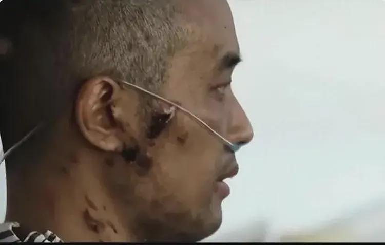 全身溃烂生不如死,暴瘦40斤,武汉首批新冠患者如今过得如何?(组图) - 18