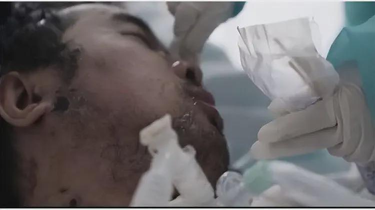 全身溃烂生不如死,暴瘦40斤,武汉首批新冠患者如今过得如何?(组图) - 12